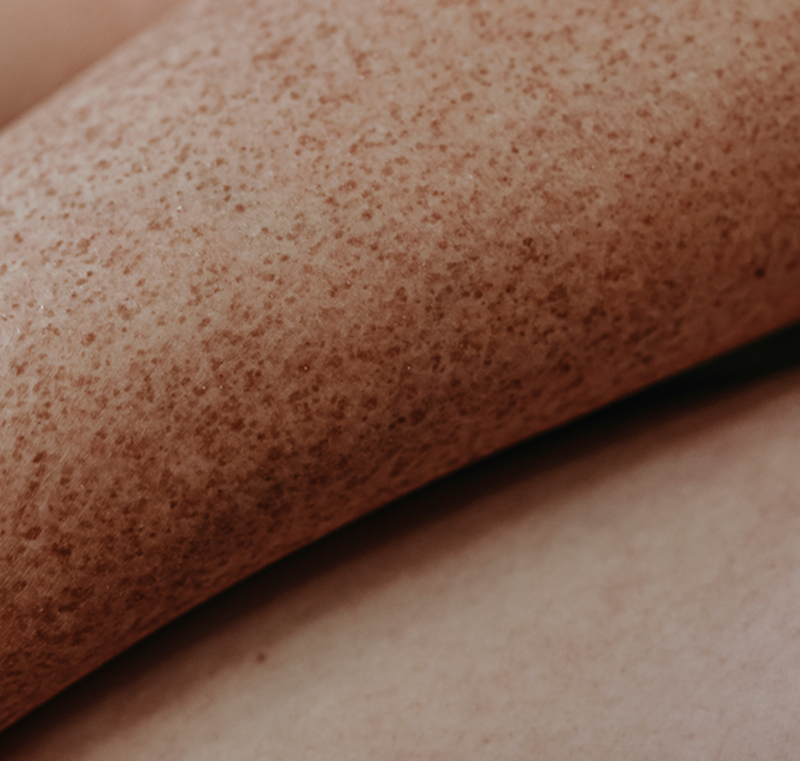 Hautarzt erklärt die Bedeutung der Hautkrebsvorsorge in Aachen.